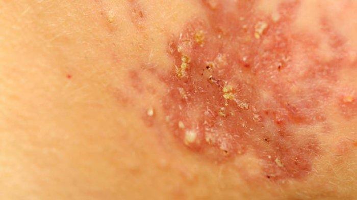 Ilustrasi penampakkan penyakit herpes, begini ulasan
