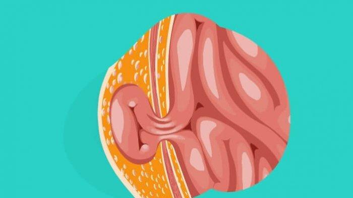 Ilustrasi penyakit hernia
