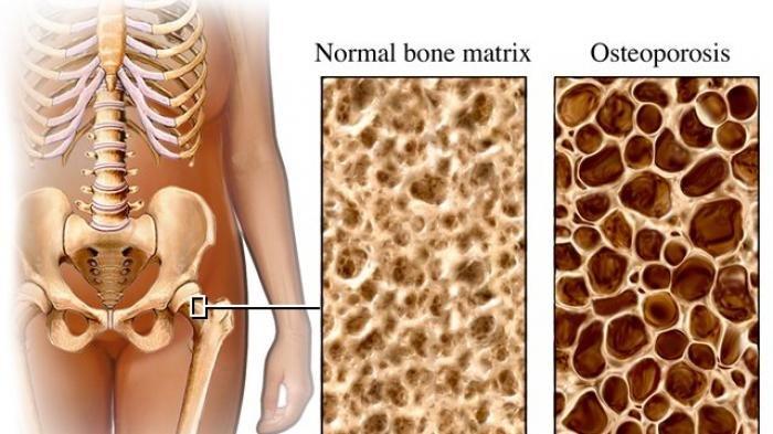 Ilustrasi penyakit osteoporosis