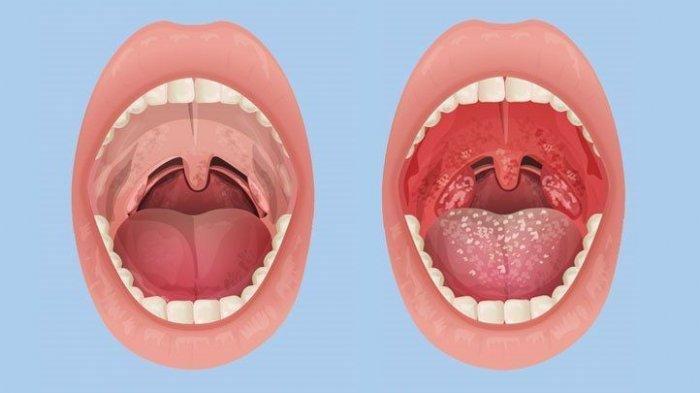 Ilustrasi penyakit tonsilitis atau radang amandel