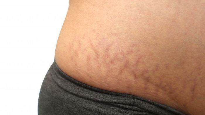 Ilustrasi stretch mark, berikut ini kebiasaan yang bisa sebabkan timbulnya stretch mark