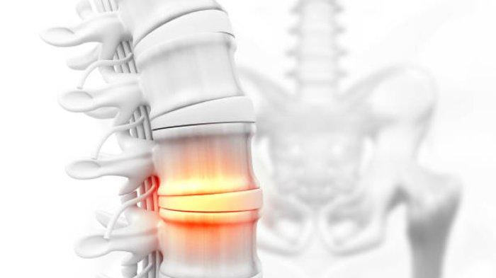 Ilustrasi reumatik tulang belakang, begini ulasan