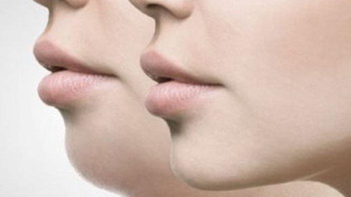 Ilustrasi sebelum dan sesudah treatment double chin
