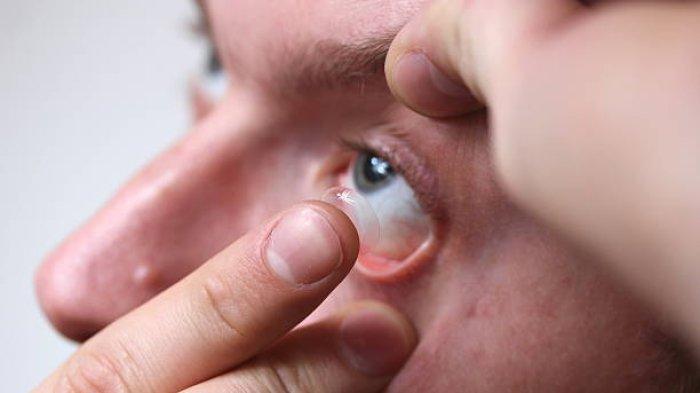 Ilustrasi softlens yang dipasangkan pada mata