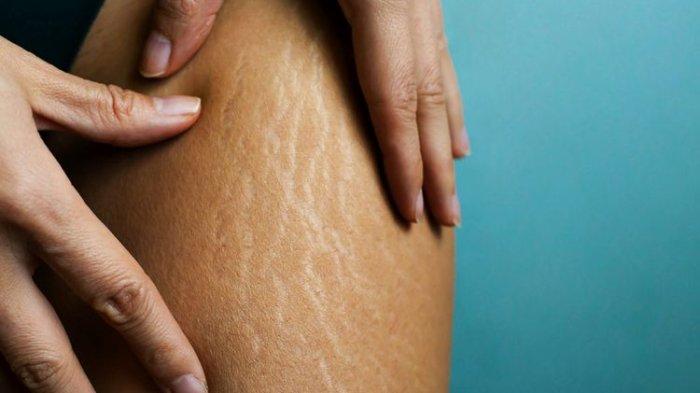 Ilustrasi seseorang yang memiliki stretch mark, berikut makanan yang dapat mengurangi risiko stretch mark