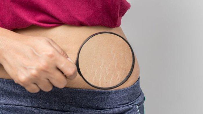 Ilustrasi munculnya stretch mark, pola makan yang buruk dan kurang minum air putih bisa meningkatkan risiko timbulnya stretch mark