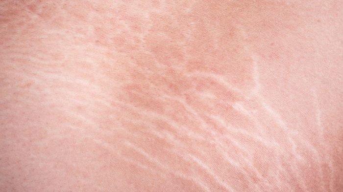 Ilustrasi seseorang yang mengalami stretch mark, apakah bisa dihilangkan dengan bahan alami?