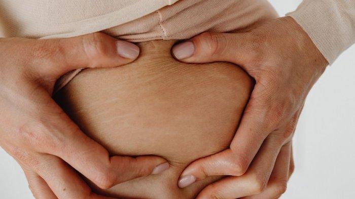 Ilustrasi stretch mark, benarkah seorang wanita yang menstruasi rentan alami stretch mark?