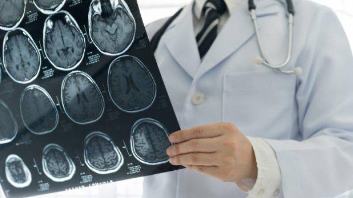 Ilustrasi stroke menyerang usia muda dibawah 45 tahun