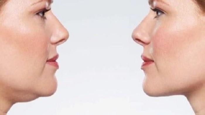 Ilustrasi orang kurus yang mengalami double chin, berikut penyebab dan cara mengatasinya