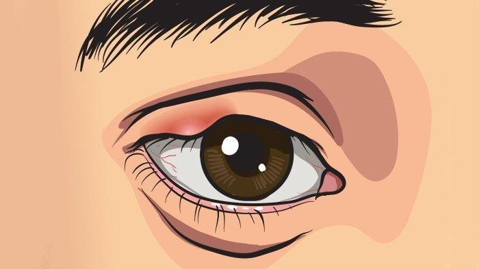 Ilustrasi terjadinya mata bintitan