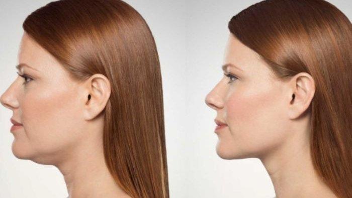 Ilustrasi wanita memiliki dagu berlipat atau double chin