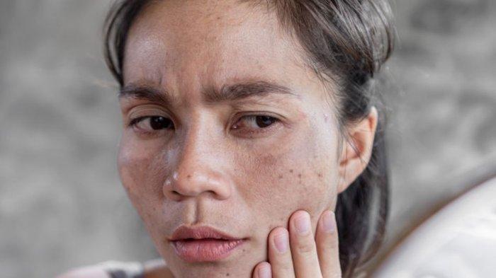 Ilustrasi wanita mengalami yang mengalami masalah melasma atau flek hitam