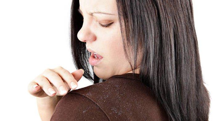 Ilustrasi seseorang yang mengalami ketombe, berikut penjelasan Dokter Spesialis Kulit dan Kelamin mengenai ketombe