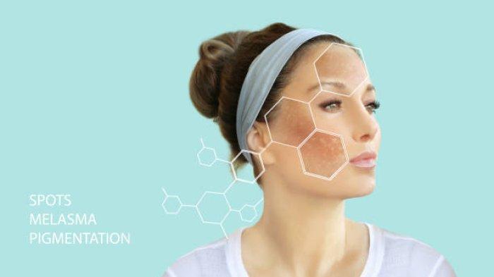 Ilustrasi wanita yang mengeluhkan adanya melasma