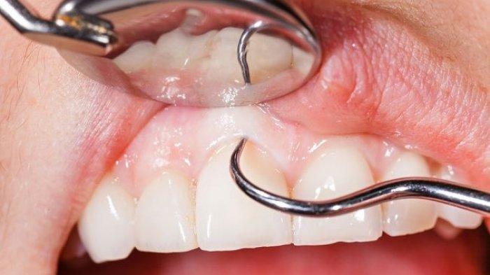 ilustrasi seseorang yang mengalami infeksi pada gusi