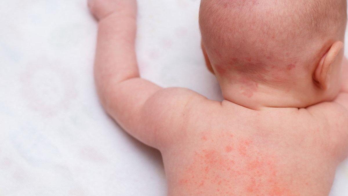ilustrasi bayi yang memiliki kulit sensitif, berikut hal yang perlu diperhatikan saat kulit bayi sensitif