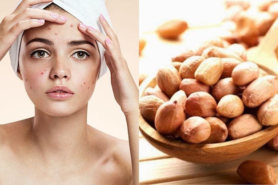 ilustraso konsumsi kacang pengaruhi jerawat