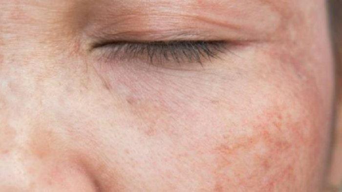 ilustrasi seseorang yang mengalami kanker kulit akibat penggunaan skincare abal-abal