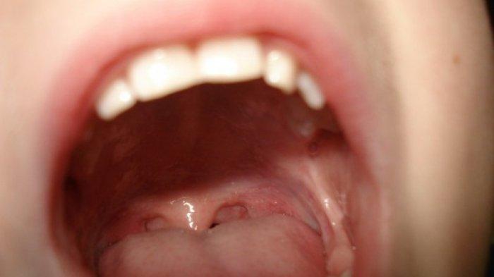 ilustrasi penderita kanker mulut