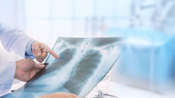 ilustrasi pengobatan kanker paru