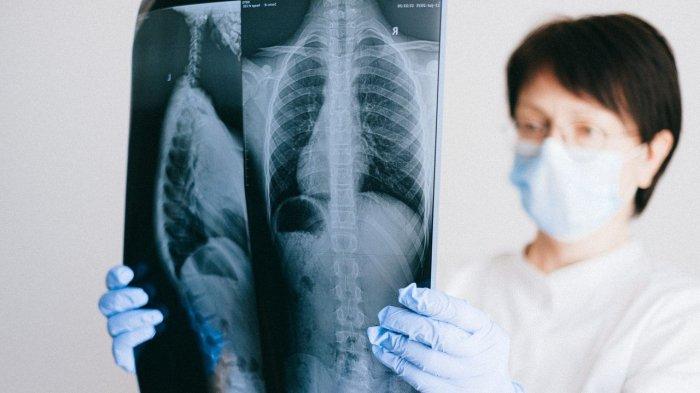 ilustrasi melakukan skrining paru untuk mendeteksi PPOK, berikut penjelasan Dokter Spesialis Paru