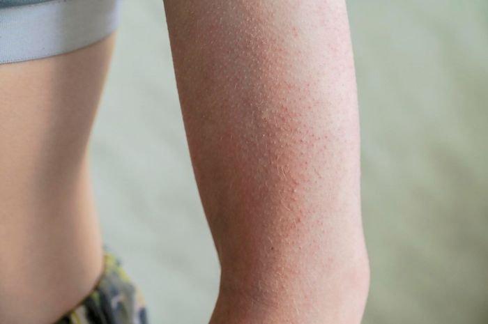 ilustrasi keratosis pilaris atau chicken skin