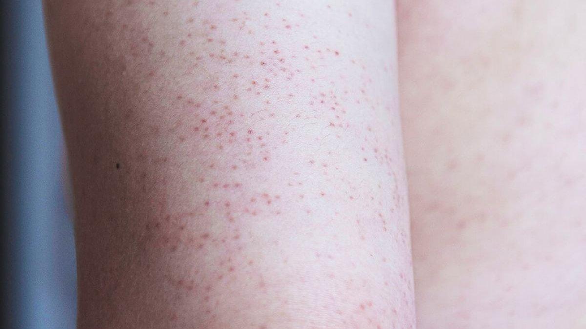 ilustrasi keratosis pilaris atau chicken skin