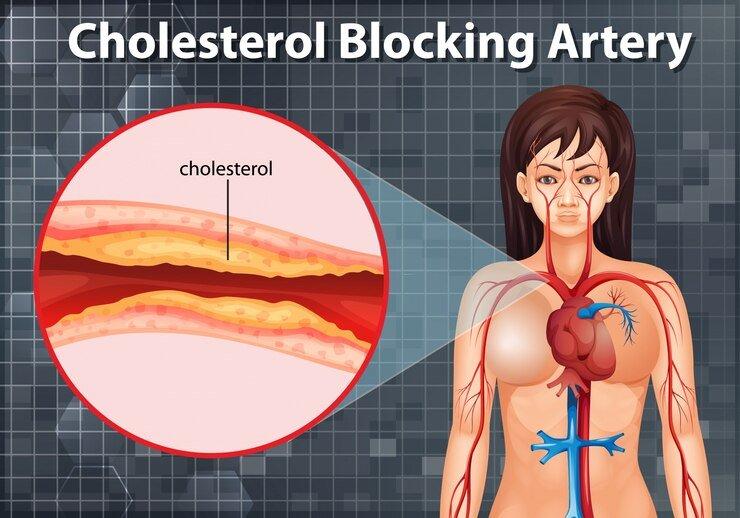 ilustrasi penumpukan kolesterol yang menyumbat arteri