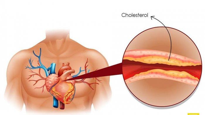ilustrasi kolesterol