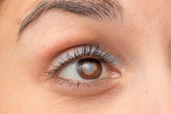 ilustrasi kondisi kornea mata putih akibat penggunaan softlens kadaluarsa