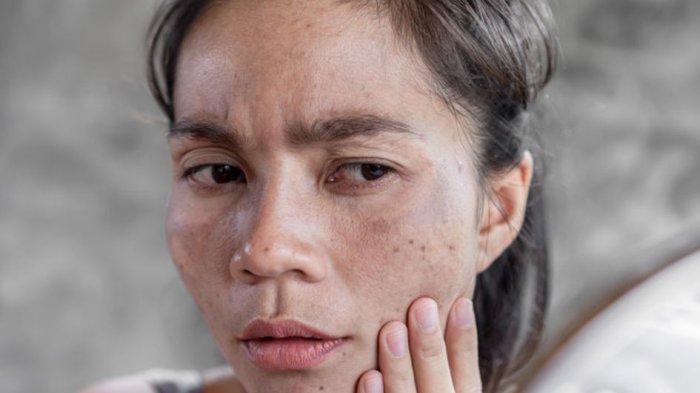 ilustrasi menggunakan krim steroid, berikut tanda-tanda kulit yang gunakan krim steroid