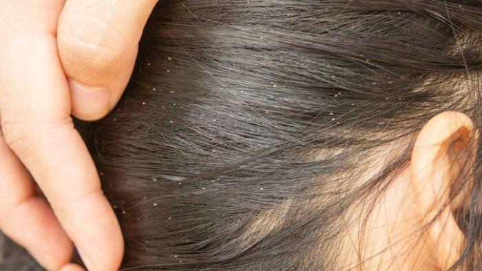 ilustrasi seseorang yang mengalami masalah kutu rambut