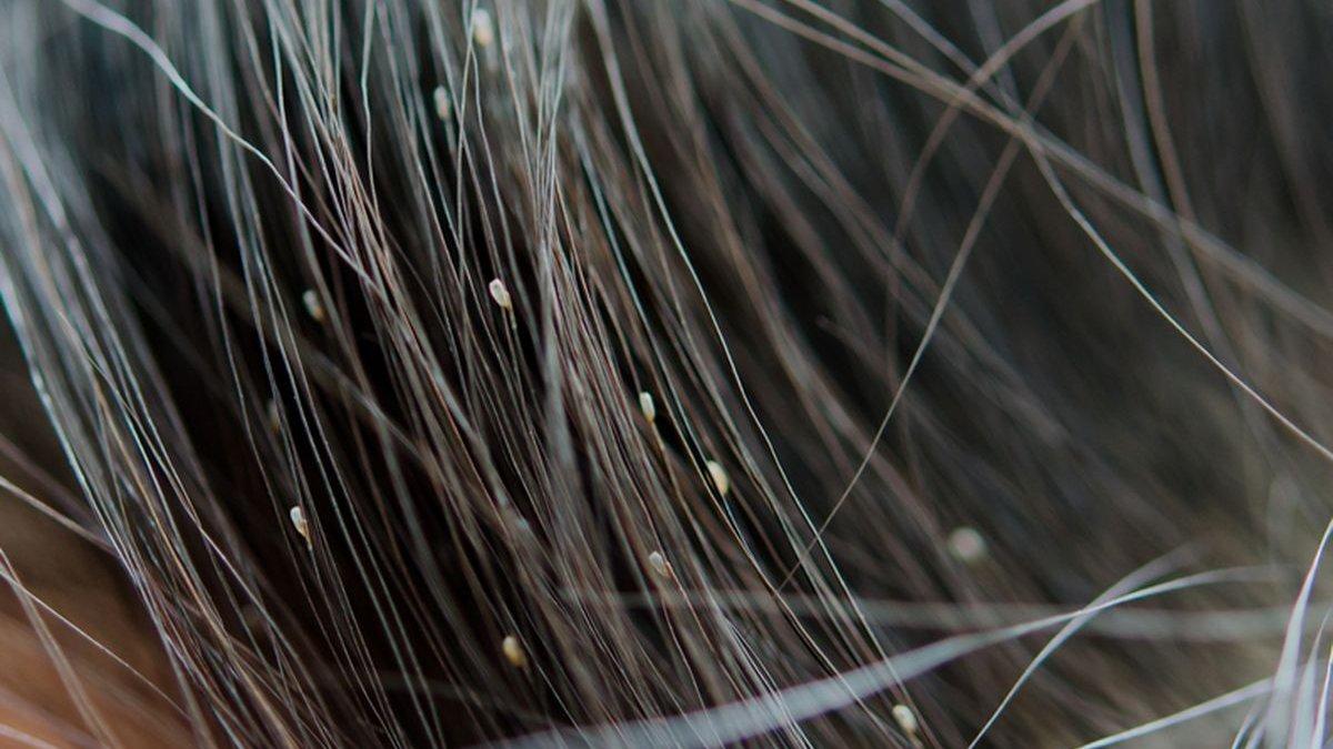 ilustrasi kutu rambut