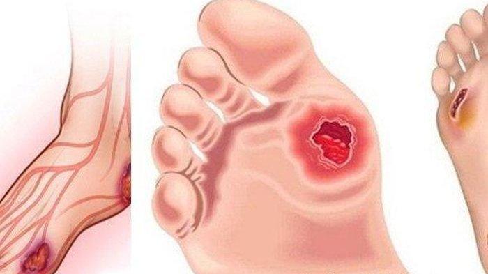 ilustrasi kaki diabetik