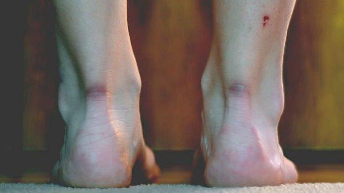 Pasien Diabetes Coba Lakukan Senam Kaki Diabetes dan Rasakan Manfaatnya, Berikut Langkahnya