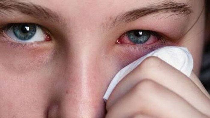 ilustrasi adanya kutil di area mata