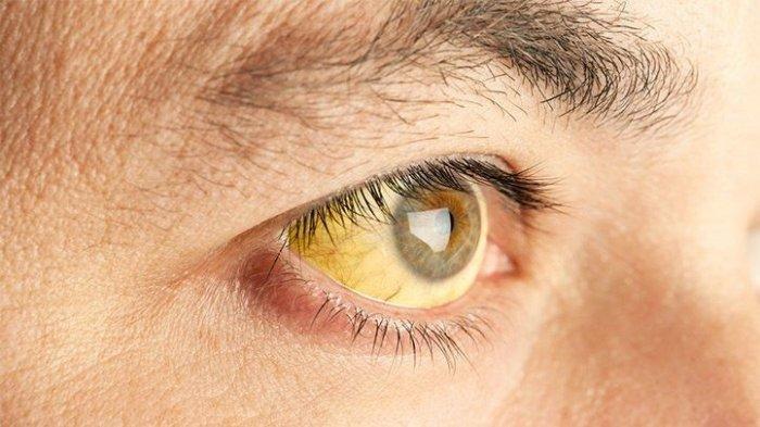 ilustrasi mata kuning pada penderita hepatitis