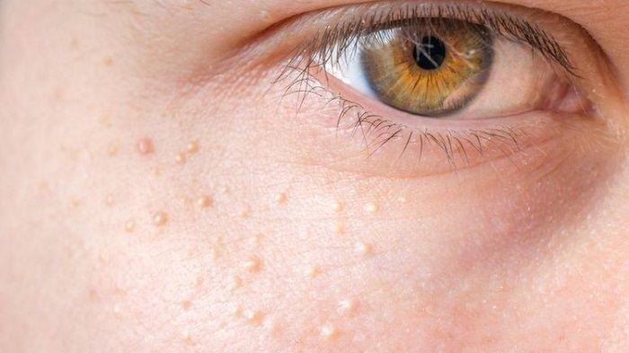 Ilustrasi milia, berikut ini penyebab milia