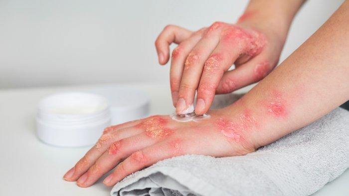Ilustrasi monkeypox atau cacar monyet, ilmuwan mewaspadai adanya kasus tanpa gejala