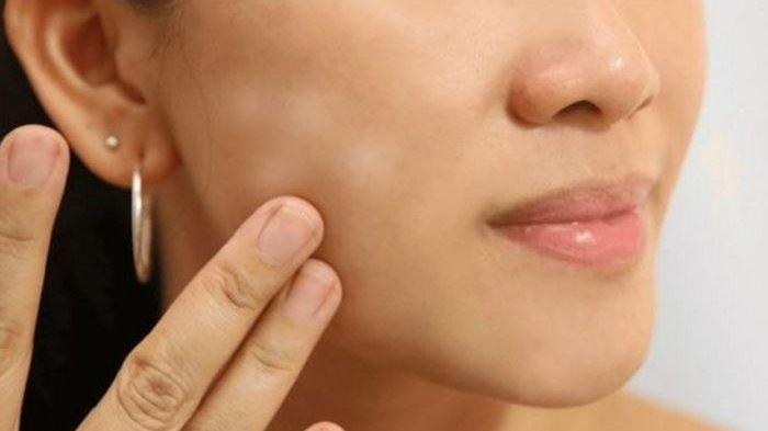 ilustrasi seseorang yang mengalami masalah panu pada wajah