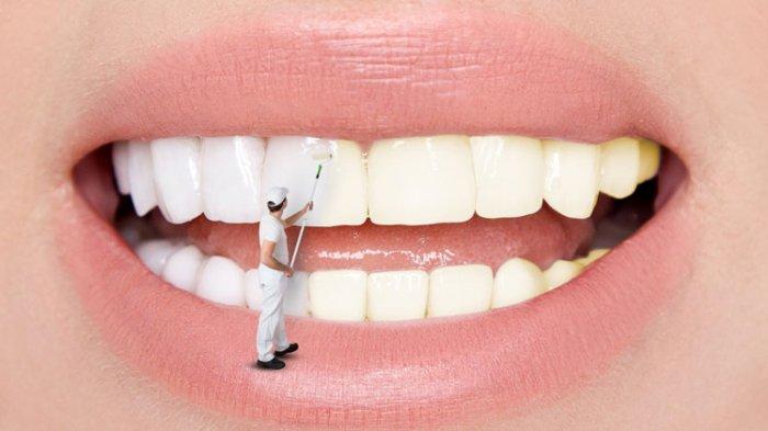 ilustrasi pemutihan gigi dengan bleaching