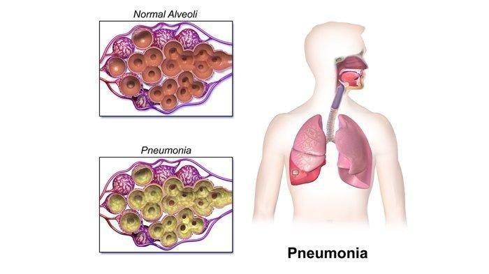 ilustrasi penyakit pneumonia