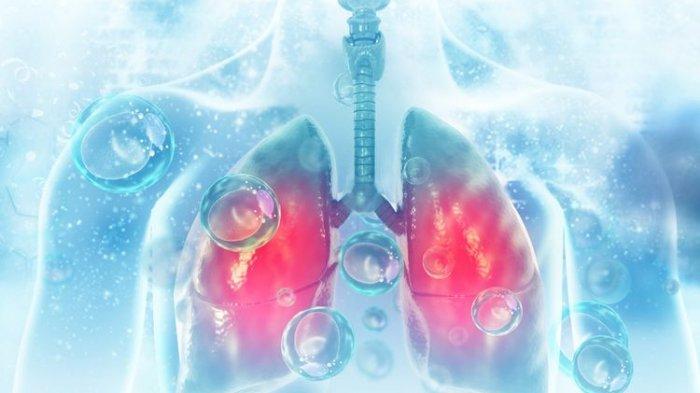 ilustrasi penyakit pneumonia