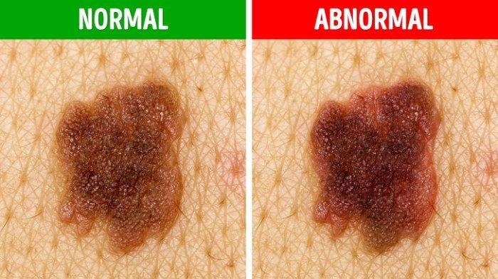 ilustrasi perbedaan melanoma dan tahi lalat