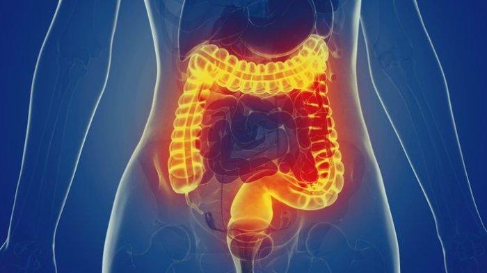 ilustrasi radang usus