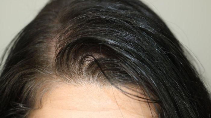 ilustrasi rambut berminyak, berikut ini beberapa cara untuk atasi rambut berminyak