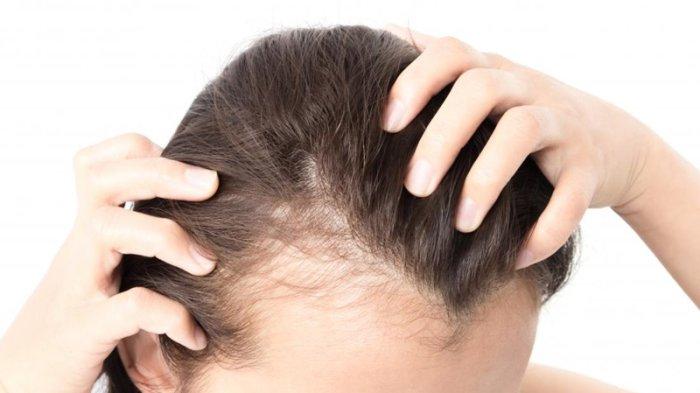 ilustrasi rambut rontok yang memicu kebotakan