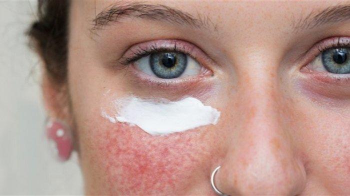 ilustrasi seseorang yang mengalami rosacea