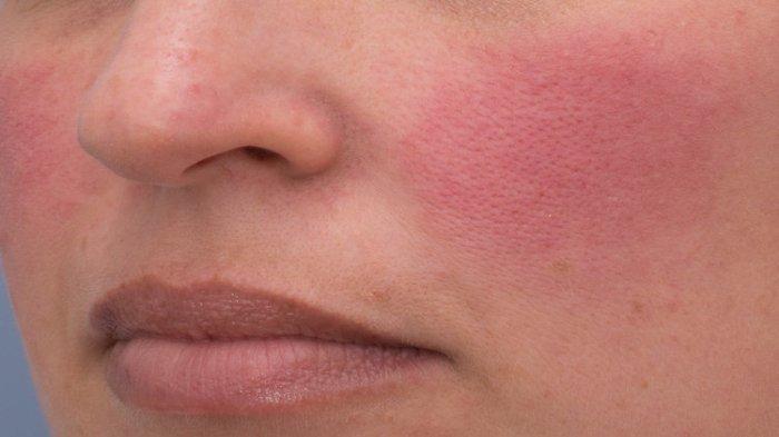 Ilustrasi kulit yang mengalami rosacea, berikut ini beberapa jenis rosacea